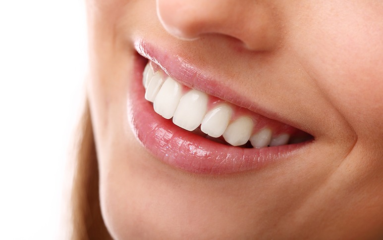 Porcelain Veneers | Point McKay Dental | General & Family Dentist | NW Calgary