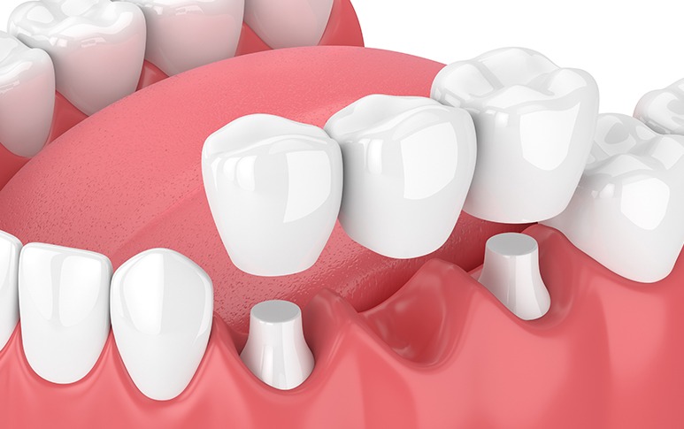 Dental Bridges | Point McKay Dental | General & Family Dentist | NW Calgary