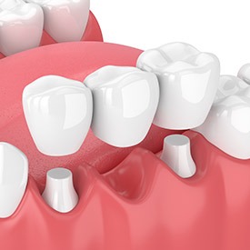 Dental Bridges | Point McKay Dental | General & Family Dentist | NW Calgary