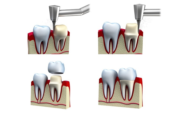 Dental Crown Process | Point McKay Dental | General & Family Dentist | NW Calgary