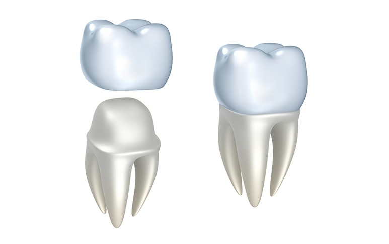 Dental Crowns | Point McKay Dental | General & Family Dentist | NW Calgary