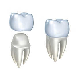 Dental Crowns | Point McKay Dental | General & Family Dentist | NW Calgary