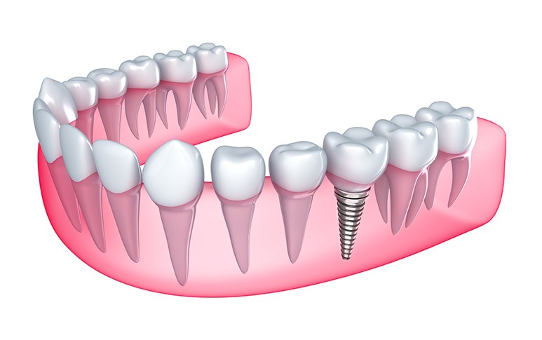 Dental Implants | Point McKay Dental | General & Family Dentist | NW Calgary