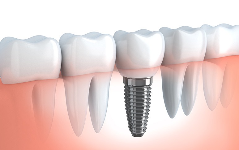 Dental Implants | Point McKay Dental | General & Family Dentist | NW Calgary