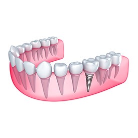 Dental Implants | Point McKay Dental | General & Family Dentist | NW Calgary