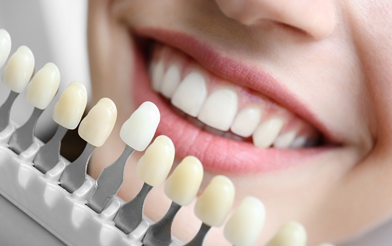 Porcelain Veneers | Point McKay Dental | General & Family Dentist | NW Calgary