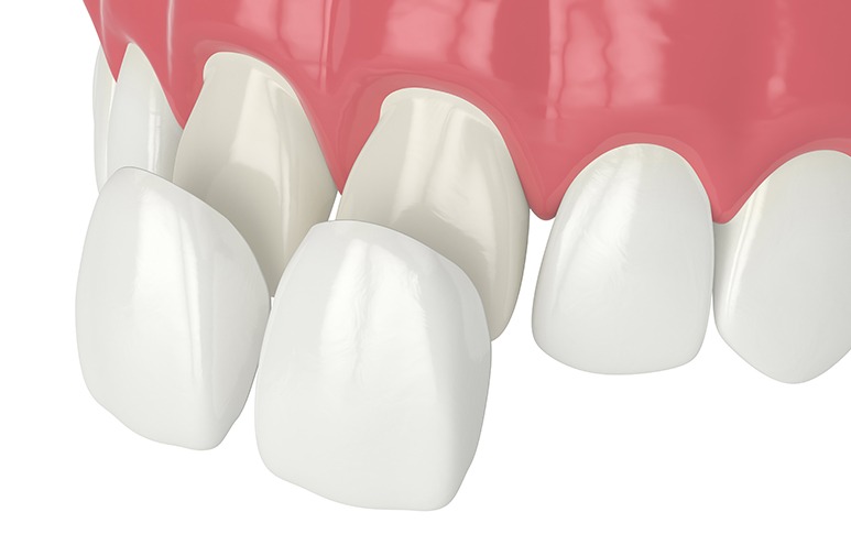 Porcelain Veneers | Point McKay Dental | General & Family Dentist | NW Calgary