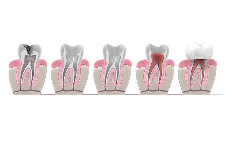 Root Canal Process | Point McKay Dental | General & Family Dentist | NW Calgary