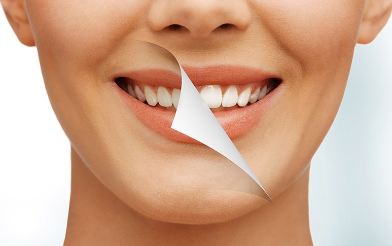 Teeth Whitening | Point McKay Dental | General & Family Dentist | NW Calgary