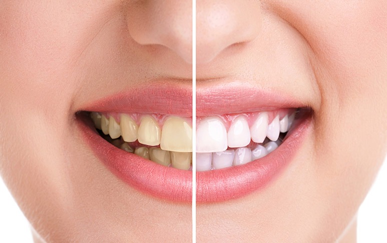 Teeth Whitening | Point McKay Dental | General & Family Dentist | NW Calgary