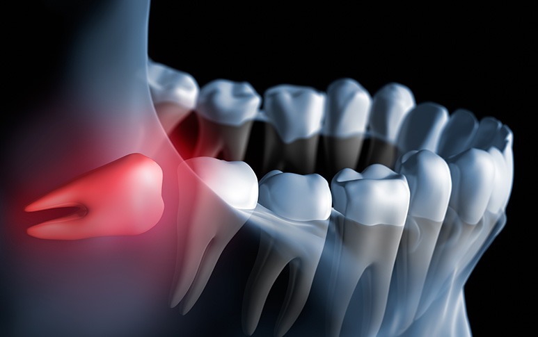 Wisdom Teeth Extractions | Point McKay Dental | General & Family Dentist | NW Calgary