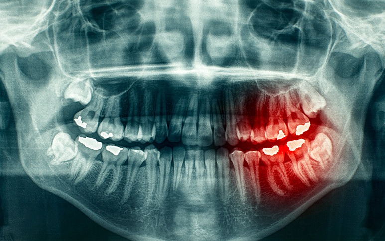 Wisdom Teeth Extractions | Point McKay Dental | General & Family Dentist | NW Calgary